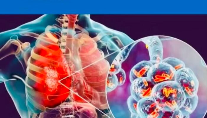 Sosialisai Bahaya Pneumonia dan Cara Mencegahnya